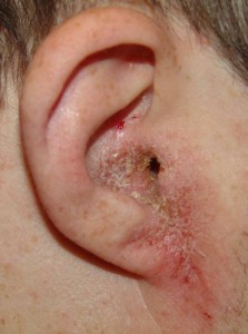 Otitis externa (reproduced with permission from Otolaryngology Houston www.houstonoto.com)